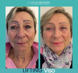 Lifting viso - Prof. Francesco Leva