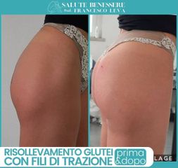 Filler glutei - Prof. Francesco Leva