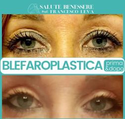 Blefaroplastica - Prof. Francesco Leva