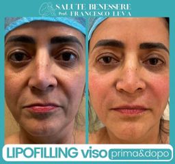 Lipofilling viso - Prof. Francesco Leva