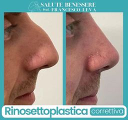 Rinosettoplastica - Prof. Francesco Leva