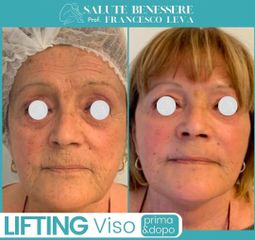 Lifting viso - Prof. Francesco Leva