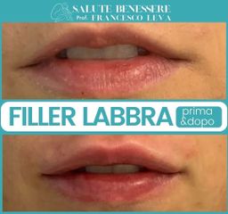 Filler labbra - Prof. Francesco Leva