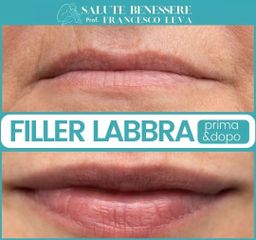 Filler labbra - Prof. Francesco Leva