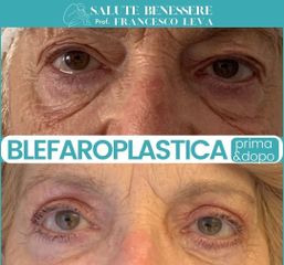 Blefaroplastica - Prof. Francesco Leva