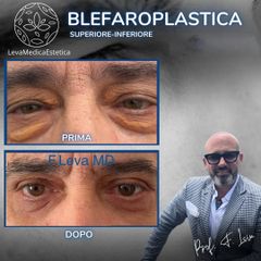 Blefaroplastica - Prof. Francesco Leva