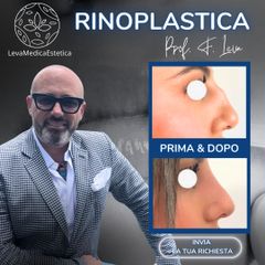 Rinoplastica - Prof. Francesco Leva