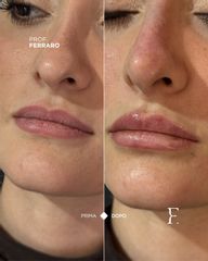 Prof. Giuseppe A. Ferraro Filler Labbra