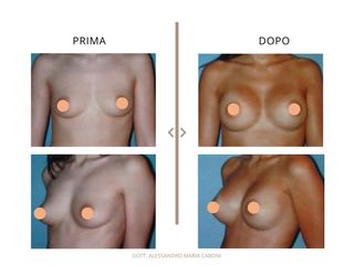 Dott. Alessandro Maria Caboni Mastoplastica additiva