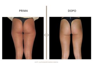 Dott. Alessandro Maria Caboni Liposuzione