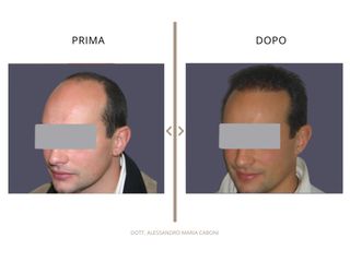 Dott. Alessandro Maria Caboni Trapianto capelli