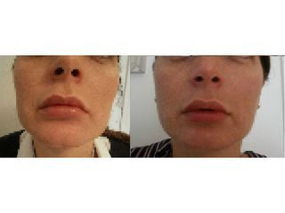 prima e dopo filler labbra