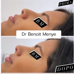 Rinofiller - Dr Benoit Menye
