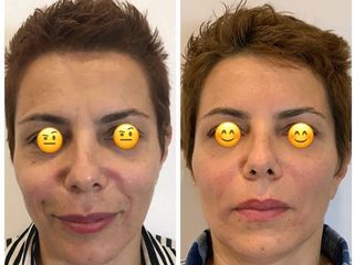 Filler e Botox prima e dopo