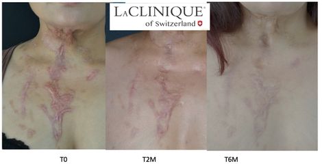 Cicatrici - LaCLINIQUE of Switzerland®