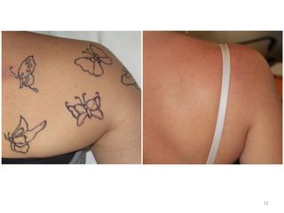 Tatuaggio Rimozione prima e dopo