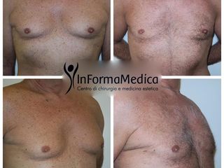 Prima e dopo intervento di ginecomastia