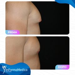 Ginecomastia - InFormaMedica - Centro di Chirurgia e Medicina Estetica