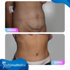 Addominoplastica - InFormaMedica - Centro di Chirurgia e Medicina Estetica