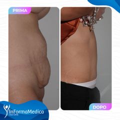 Addominoplastica - InFormaMedica - Centro di Chirurgia e Medicina Estetica