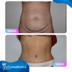 Addominoplastica - InFormaMedica - Centro di Chirurgia e Medicina Estetica