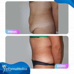 Addominoplastica - InFormaMedica - Centro di Chirurgia e Medicina Estetica