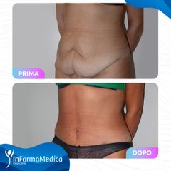 Addominoplastica - InFormaMedica - Centro di Chirurgia e Medicina Estetica