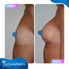 Mastoplastica additiva - InFormaMedica - Centro di Chirurgia e Medicina Estetica
