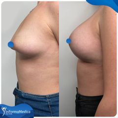 Mastoplastica additiva - InFormaMedica - Centro di Chirurgia e Medicina Estetica