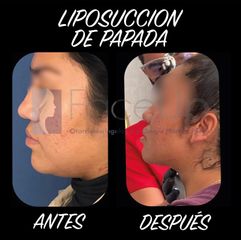 Cirugía de papada - Face Up Puebla