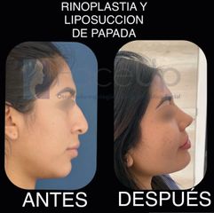 Rinoplastia - Face Up Puebla