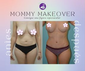 Mommy Makeover - Dra. Jessica Ramírez Cadena