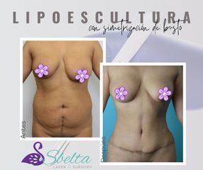 Abdominoplastía con lipo 360 - - Dra. Jessica Ramírez Cadena
