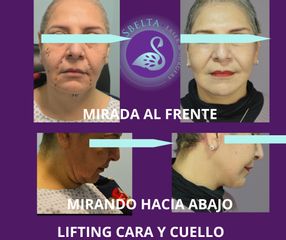 Lifting Facial - Dra. Jessica Ramírez Cadena