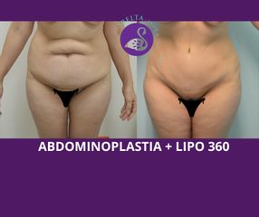 Abdominoplastia -Dra. Jessica Ramírez Cadena