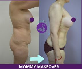 Mommy makeover - Dra. Jessica Ramírez Cadena