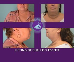 Lifting de cuello y escote - Dra. Jessica Ramírez Cadena