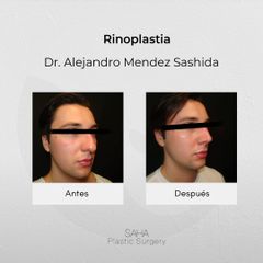 Rinoplastia - Dr. Alejandro Méndez Sashida