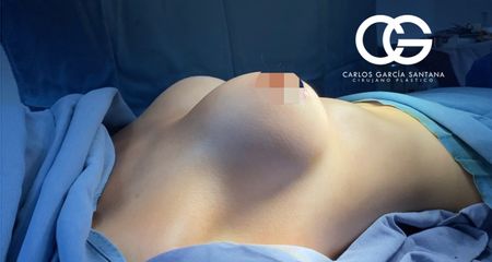 Implantes mamarios - Dr. Carlos Santana