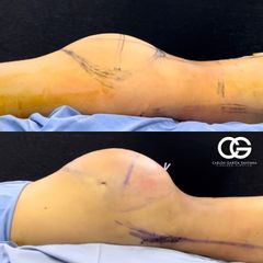 Lipoescultura - Dr. Carlos Santana
