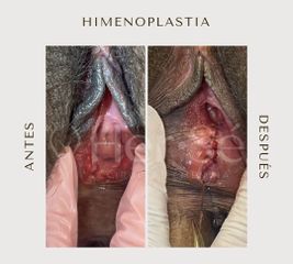 Himenoplastia - Her Sé