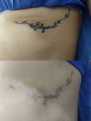 Eliminación de tatuaje - Centros Euroestetica Toluca