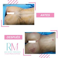 Antes y después de lipo 360 - Dra. Rosy Mercado  