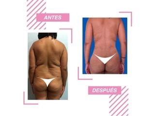 Antes y después de liposucción - Dra. Rosy Mercado