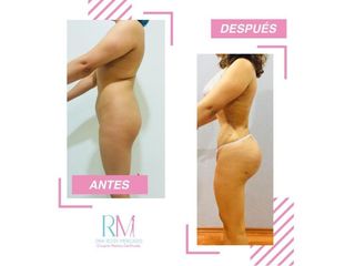 Antes y después de Liposucción