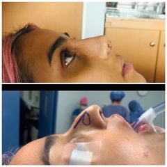 Antes y después de rinoplastia - Dra. Rosy Mercado