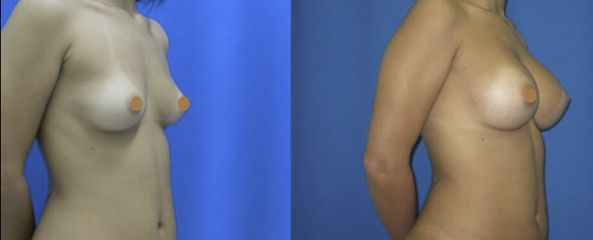 Antes y después de Aumento de busto