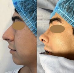 Antes y después de Rinoplastia