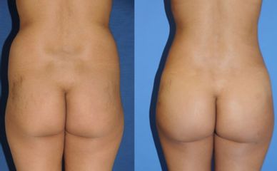 Antes y después de Liposucción