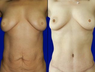 Antes y después de Abdominoplastia